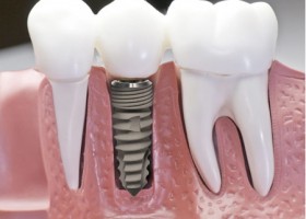 Cắm ghép implant