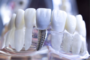 Cấy ghép implant ở đâu tốt nhất hiện nay?