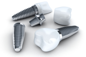 Cấy ghép răng Implant giá bao nhiêu hiện nay?