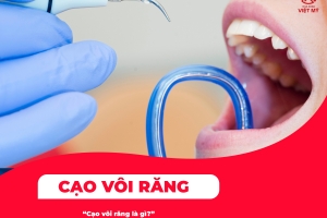 Tìm hiểu cạo vôi răng là gì?