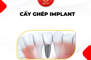 Tìm Hiểu Sâu Về Quy Trình Cấy Ghép Implant